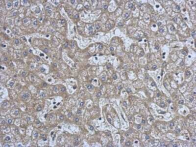 Immunohistochemistry-Paraffin: NMT2 Antibody [NBP2-19555] - Immunohistochemical analysis of paraffin-embedded Hepatoma, using antibody at 1:500 dilution.