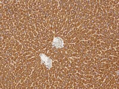 Immunohistochemistry-Paraffin: NMT2 Antibody [NBP2-99170] - Immunochemical staining NMT2 in human breast carcinoma with rabbit polyclonal antibody at 1:300 dilution, formalin-fixed paraffin embedded sections.