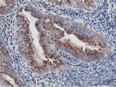 Immunohistochemistry: NMT2 Antibody (OTI1G3) - Azide and BSA Free [NBP2-73021] - Staining of paraffin-embedded Adenocarcinoma of Human endometrium tissue using anti-NMT2 mouse monoclonal antibody.