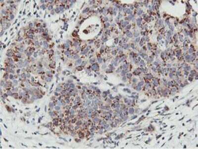 Immunohistochemistry: NMT2 Antibody (OTI1G3) - Azide and BSA Free [NBP2-73021] - Staining of paraffin-embedded Carcinoma of Human lung tissue using anti-NMT2 mouse monoclonal antibody.