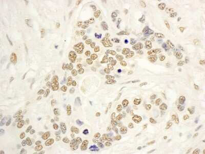<b>Independent Antibodies Validation and Biological Strategies Validation.</b>Immunohistochemistry: NOL8 Antibody [NBP1-46850] - Sample: FFPE section of human ovarian carcinoma. Antibody: Affinity purified rabbit anti- NOP132 used at a dilution of 1:5,000 (0.2ug/ml). Detection: DAB