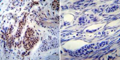 Immunohistochemistry-Paraffin: NONO Antibody (78-1 C) [NB100-74478] - Both normal and cancer biopsies of deparaffinized human Bladder carcinoma tissue.