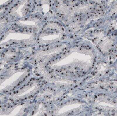 Immunohistochemistry: NOP56 Antibody (CL2603) [NBP2-36778] - Staining of human prostate cancer shows strong nucleolar positivity in glandular cells.