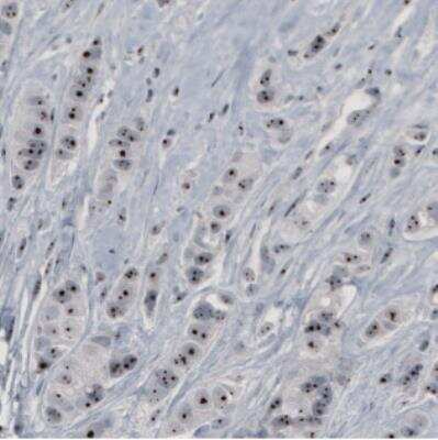 Immunohistochemistry: NOP56 Antibody (CL2603) [NBP2-36778] - Staining of human breast cancer shows strong nucleolar positivity in tumor cells.