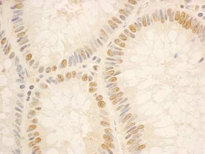 <b>Independent Antibodies Validation and Biological Strategies Validation.</b>Immunohistochemistry: NOP56 Antibody [NBP1-46848] - Sample: FFPE section of human colon carcinoma. Antibody: Affinity purified rabbit anti- NOP56 used at a dilution of 1:1,000 (0.2ug/ml). Detection: DAB