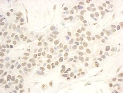 <b>Independent Antibodies Validation and Biological Strategies Validation.</b>Immunohistochemistry-Paraffin: NOP56 Antibody [NBP1-46847] - Sample: FFPE section of human breast carcinoma. Antibody: Affinity purified rabbit anti-NOP56 used at a dilution of 1:200 (1ug/ml). Detection: DAB