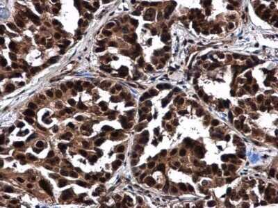 Immunohistochemistry-Paraffin: NOP56 Antibody [NBP3-12977] - NOP56 antibody detects NOP56 protein at cytoplasm and nucleus in human breast carcinoma by immunohistochemical analysis. Sample: Paraffin-embedded human breast carcinoma. NOP56 antibody (NBP3-12977) diluted at 1:500. Antigen Retrieval: Citrate buffer, pH 6.0, 15 min