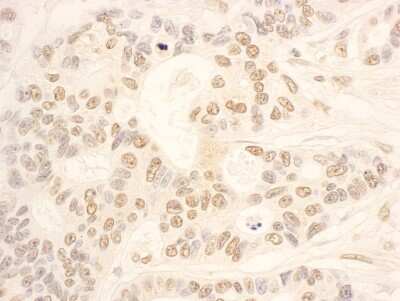 Immunohistochemistry-Paraffin: NOP58 Antibody [NBP1-46846] - Sample: FFPE section of human ovarian carcinoma. Antibody: Affinity purified rabbit anti- NOP58 used at a dilution of 1:1,000 (0.2ug/ml). Detection: DAB