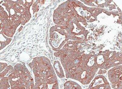 Immunohistochemistry-Paraffin: NOV/CCN3 Antibody [NBP1-31416] - Sastric cancer N87 xenograft, using NOV antibody at 1:100 dilution. Antigen Retrieval: Trilogy™ (EDTA based, pH 8.0) buffer, 15min. 