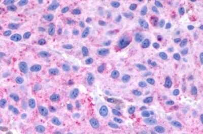 Immunohistochemistry-Paraffin: NPBWR1 Antibody [NLS171] - Anti-NPBWR1 / GPR7 antibody IHC of human Skin, Melanoma. Immunohistochemistry of formalin-fixed, paraffin-embedded tissue after heat-induced antigen retrieval.