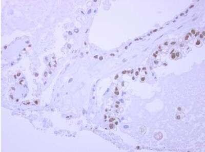 Immunohistochemistry-Paraffin: NPEPL1 Antibody [NBP2-19570] - Paraffin-embedded ovarian carcinoma. NPEPL1 antibody [N2C1], Internal  dilution: 1:500.