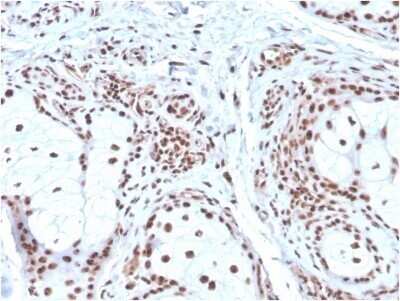 Immunohistochemistry-Paraffin: NPM1 Antibody (NPM1/3286) - Azide and BSA Free [NBP2-79875] - Formalin-fixed, paraffin-embedded human Basal Cell Carcinoma stained with NPM1 Antibody (NPM1/3286).