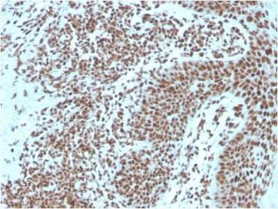 Immunohistochemistry-Paraffin: NPM1 Antibody (NPM1/3287) - Azide and BSA Free [NBP2-79876] - Formalin-fixed, paraffin-embedded human Basal Cell Carcinoma stained with NPM1 Antibody (NPM1/3287).