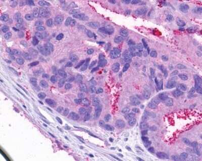 Immunohistochemistry-Paraffin: NPY4R Antibody [NLS1071] - Analysis of anti-NPY4R / PPYR1 antibody with human colon, carcinoma.