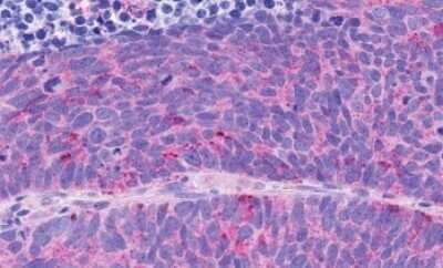 Immunohistochemistry-Paraffin: NPY4R Antibody [NLS1071] - Anti-NPY4R / PPYR1 antibody IHC of human Lung, Small Cell Carcinoma. Immunohistochemistry of formalin-fixed, paraffin-embedded tissue after heat-induced antigen retrieval.