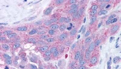 Immunohistochemistry-Paraffin: NPY4R Antibody [NLS1071] - Anti-NPY4R / PPYR1 antibody IHC of human Skin, Melanoma. Immunohistochemistry of formalin-fixed, paraffin-embedded tissue after heat-induced antigen retrieval.