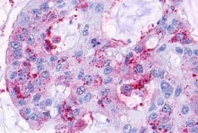Immunohistochemistry: NPY5R Antibody [NBP3-14427] - Immunohistochemistry of colon carcinoma