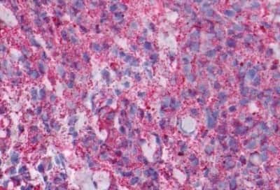 Immunohistochemistry-Paraffin: NPY5R Antibody [NBP3-14427] - Immunohistochemistry of formalin-fixed, paraffin-embedded human skin melanoma after heat-induced antigen retrieval.