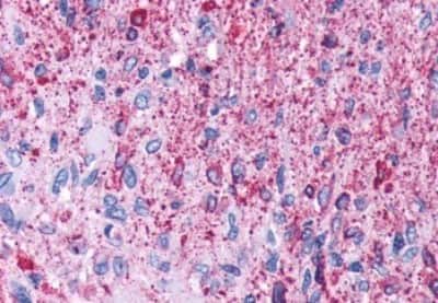Immunohistochemistry-Paraffin: NPY5R Antibody [NBP3-14427] - Immunohistochemistry of formalin-fixed, paraffin-embedded human brain, glioblastoma, after heat-induced antigen retrieval.