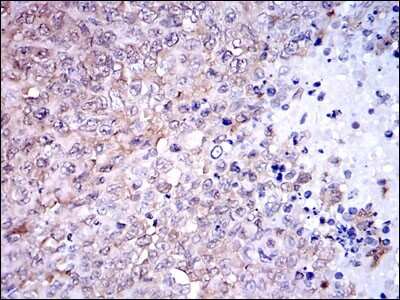 Immunohistochemistry: NQO-1 Antibody (4D12) [NBP2-37541] - Immunohistochemical analysis of paraffin-embedded ovarian cancer tissues using NQO1 mouse mAb with DAB staining.