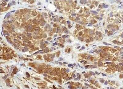 Immunohistochemistry: NQO-1 Antibody (A180) - Azide and BSA Free [NBP2-80885] - Analysis of NQO1 in human breast cancer using DAB with hematoxylin counterstain. Image from the standard format of this antibody.