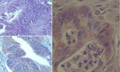 Immunohistochemistry-Paraffin: NQO-1 Antibody [NBP2-23792] -  Analysis of NQO1 in formalin-fixed, paraffin-embedded human stomach tumor using an isotype control (top left) and NBP2-23792(bottom left, right) at 7 ug/ml.
