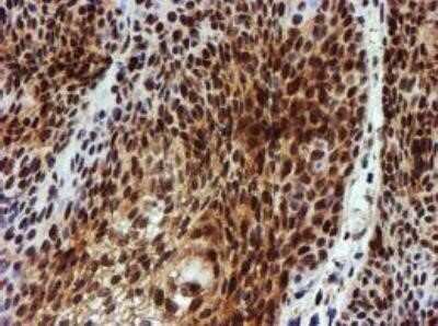 Immunohistochemistry: NQO-2 Antibody (OTI3G4) - Azide and BSA Free [NBP2-73049] - Carcinoma of Human bladder tissue.