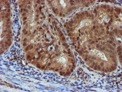 Immunohistochemistry: NQO-2 Antibody (OTI3G4) - Azide and BSA Free [NBP2-73049] - Staining of paraffin-embedded Adenocarcinoma of Human endometrium tissue using anti-NQO2 mouse monoclonal antibody.