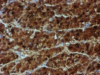 Immunohistochemistry: NQO-2 Antibody (OTI3G4) - Azide and BSA Free [NBP2-73049] - Staining of paraffin-embedded Carcinoma of Human liver tissue using anti-NQO2 mouse monoclonal antibody.