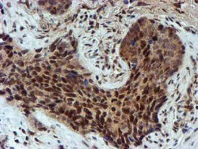 Immunohistochemistry: NQO-2 Antibody (OTI3G4) - Azide and BSA Free [NBP2-73049] - Staining of paraffin-embedded Carcinoma of Human lung tissue using anti-NQO2 mouse monoclonal antibody.