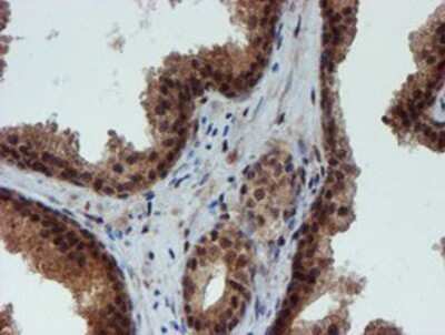 Immunohistochemistry: NQO-2 Antibody (OTI3G4) - Azide and BSA Free [NBP2-73049] - Staining of paraffin-embedded Carcinoma of Human prostate tissue using anti-NQO2 mouse monoclonal antibody.