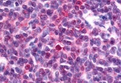 Immunohistochemistry-Paraffin: NR4A3/NOR1 Antibody [NBP1-44128] - Anti-Nor-1 / NR4A3 antibody IHC of human Lymph Node, Non-Hodgkins Lymphoma. Immunohistochemistry of formalin-fixed, paraffin-embedded tissue after heat-induced antigen retrieval.