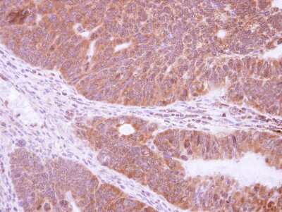 Immunohistochemistry-Paraffin: NRBP2 Antibody [NBP2-19585] - Immunohistochemical analysis of paraffin-embedded Colon ca, using antibody at 1:500 dilution.