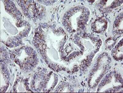 Immunohistochemistry: NRIP3 Antibody (1A9) [NBP2-45876] - Analysis of Carcinoma of Human prostate tissue.