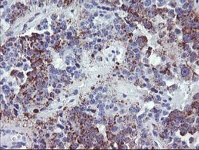 Immunohistochemistry: NRIP3 Antibody (1A9) [NBP2-45876] - Analysis of Carcinoma of Human pancreas tissue.