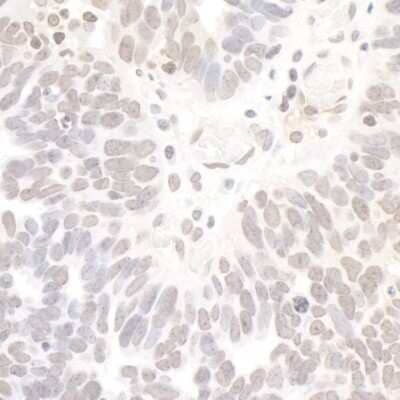 Immunohistochemistry-Paraffin: NRSF Antibody [NB100-756] - Sample: FFPE section of human ovarian carcinoma. Antibody: Affinity purified rabbit anti- REST used at a dilution of 1:1,000 (1ug/ml). Detection: DAB