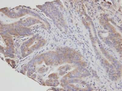 Immunohistochemistry-Paraffin: NSMAF Antibody [NBP1-31431] - Paraffin-embedded T(gastric CA), using antibody at 1:100 dilution.