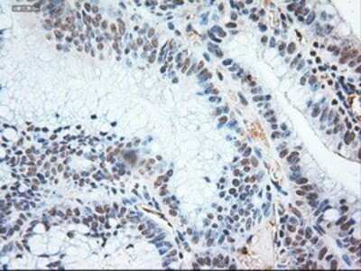 Immunohistochemistry: NT-3 Antibody (OTI5A2) - Azide and BSA Free [NBP2-72972] - Staining of paraffin-embedded Adenocarcinoma of colon using anti-NTF3 mouse monoclonal antibody.