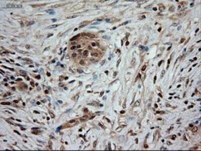 Immunohistochemistry: NT-3 Antibody (OTI5A2) - Azide and BSA Free [NBP2-72972] - Staining of paraffin-embedded Carcinoma of pancreas using anti-NTF3 mouse monoclonal antibody.