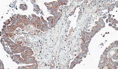 Immunohistochemistry-Paraffin: NT5C2 Antibody [NBP1-31404] - Paraffin-embedded OVCA, using antibody at 1:100 dilution.