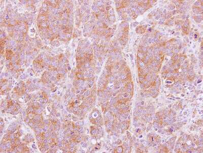 Immunohistochemistry-Paraffin: NT5C2 Antibody [NBP2-19597] - Immunohistochemical analysis of paraffin-embedded MCF7 xenograft, using antibody at 1:100 dilution.