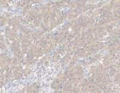 Immunohistochemistry-Paraffin: NTAN1 Antibody [NBP3-12564] - Staining of human NTAN1 in human hepatoma with rabbit polyclonal antibody at 1:100 dilution.
