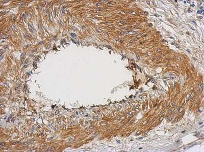 Immunohistochemistry-Paraffin: NUAK2 Antibody [NBP2-19599] - Human gastric cancer, using NUAK2 antibody at 1:500 dilution. Antigen Retrieval: Trilogy™ (EDTA based, pH 8.0) buffer, 15min. 