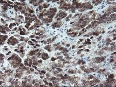 Immunohistochemistry: NUB1/NYREN18 Antibody (OTI4H2) - Azide and BSA Free [NBP2-73084] - Staining of paraffin-embedded Adenocarcinoma of Human ovary tissue using anti-NYREN18 mouse monoclonal antibody.