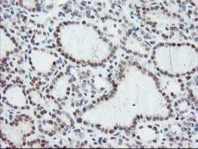 Immunohistochemistry: NUB1/NYREN18 Antibody (OTI4H2) - Azide and BSA Free [NBP2-73084] - Staining of paraffin-embedded Carcinoma of Human thyroid tissue using anti-NYREN18 mouse monoclonal antibody.