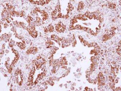 Immunohistochemistry-Paraffin: NUDCD1 Antibody [NBP2-19605] - Analysis of paraffin-embedded Lung ADCA, using antibody at 1:500 dilution.