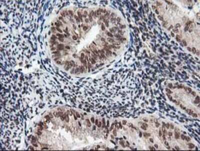 Immunohistochemistry-Paraffin: NUDT18 Antibody (5D7) [NBP2-01432] - Staining of paraffin-embedded Adenocarcinoma of Human endometrium tissue using anti-NUDT18 mouse monoclonal antibody.