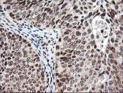 Immunohistochemistry-Paraffin: NUDT18 Antibody (5D7) [NBP2-01432] - Staining of paraffin-embedded Carcinoma of Human bladder tissue using anti-NUDT18 mouse monoclonal antibody.