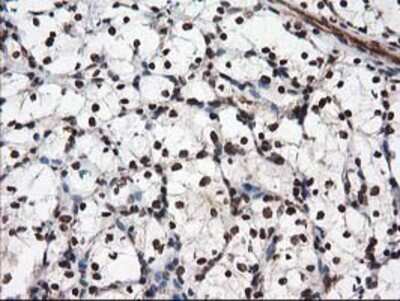 Immunohistochemistry: NUDT18 Antibody (OTI5D7) - Azide and BSA Free [NBP2-73110] - Staining of paraffin-embedded Carcinoma of Human kidney tissue using anti-NUDT18 mouse monoclonal antibody.