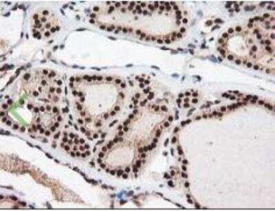 Immunohistochemistry-Paraffin: NUDT18 Antibody (OTI5D7) [NBP2-01432] - Staining of paraffin-embedded Carcinoma of Human thyroid tissue using anti-NUDT18 mouse monoclonal antibody. Heat-induced epitope retrieval by 10mM citric buffer, pH6.0, 100C for 10min.